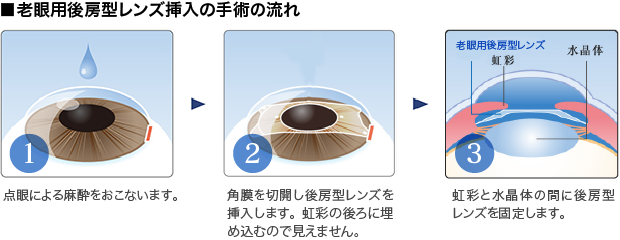 ■老眼用後房型レンズ挿入の手術の流れ