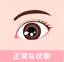 眼瞼下垂の症状 正常