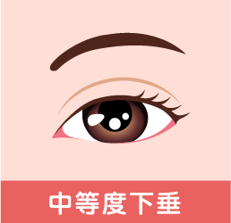 眼瞼下垂の症状 中等度下垂