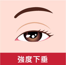 眼瞼下垂の症状 強度下垂